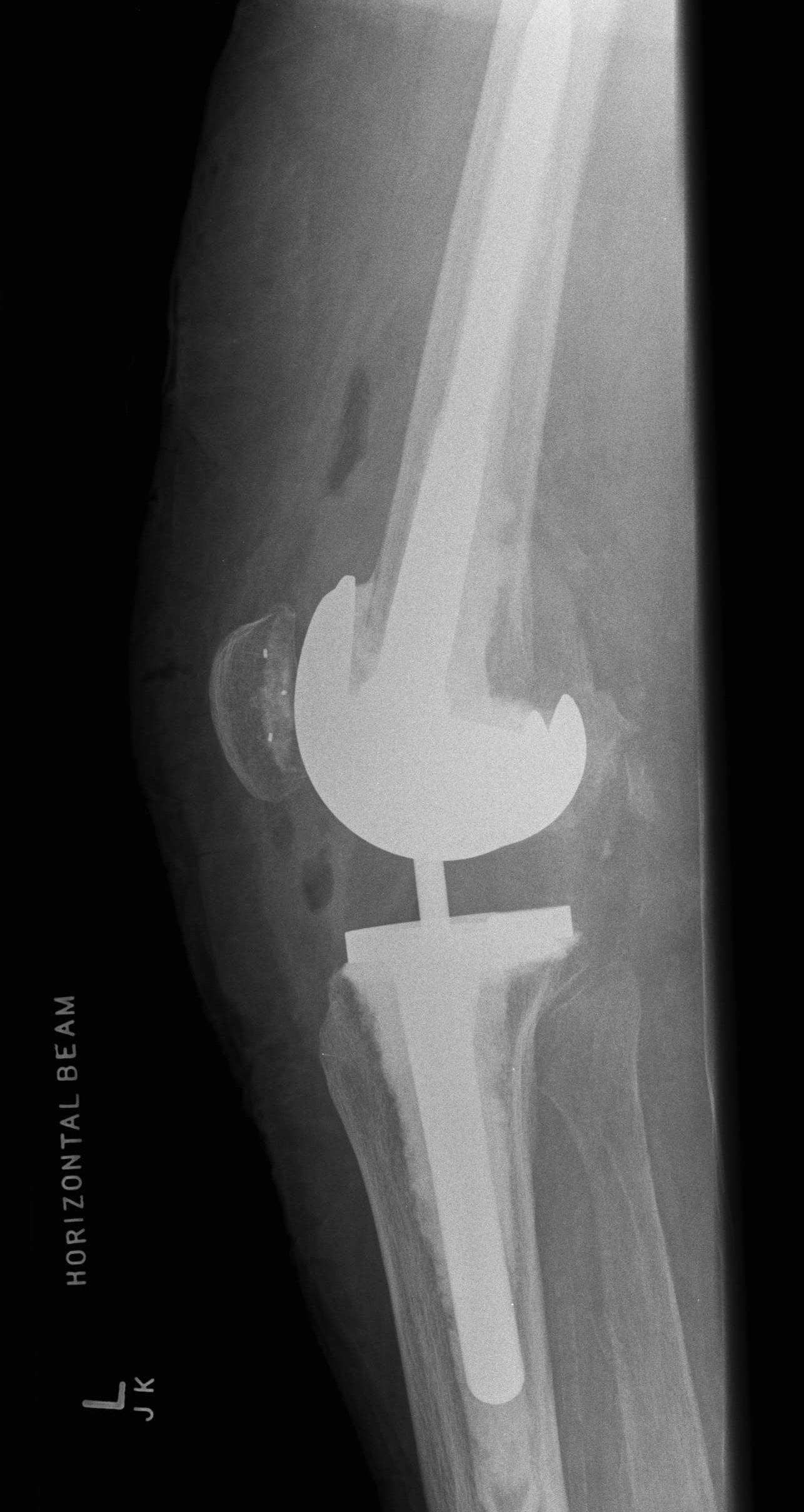 TKR Periprosthetic Fracture Revision Lateral